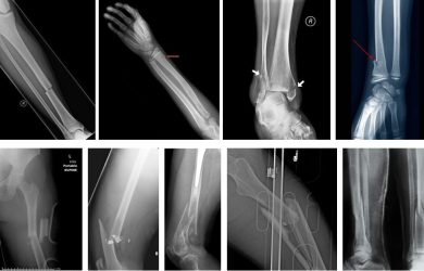 Сучасні тенденції металоостеосинтезу довгих трубчастих кісток. Накісткові пластини LCP vs інтрамедулярні стержні нового покоління.