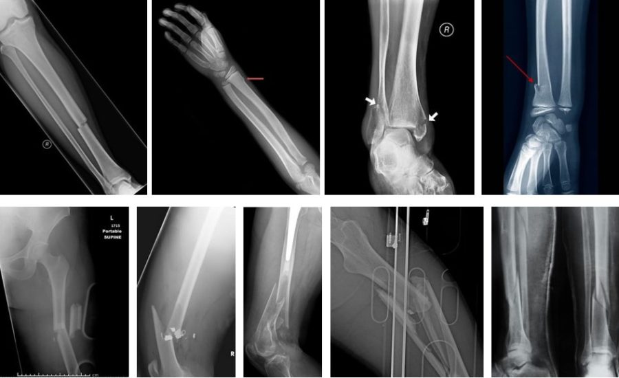 Сучасні тенденції металоостеосинтезу довгих трубчастих кісток. Накісткові пластини LCP vs інтрамедулярні стержні нового покоління.