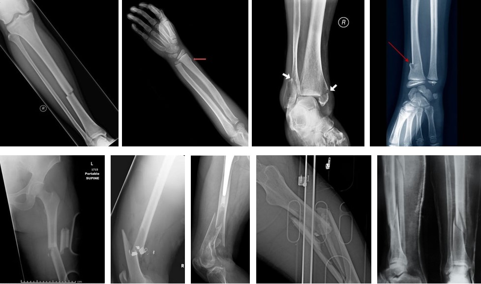 Сучасні тенденції металоостеосинтезу довгих трубчастих кісток. Накісткові пластини LCP vs інтрамедулярні стержні нового покоління.