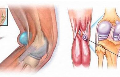 Кіста Бейкера (Baker's сyst), підколінна кіста, підколінна грижа