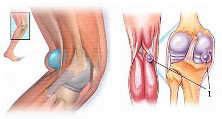 Кіста Бейкера (Baker's сyst), підколінна кіста, підколінна грижа