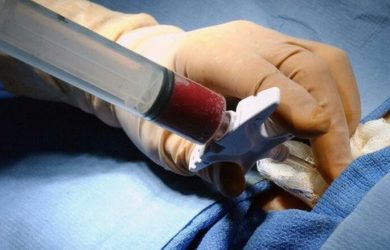 Гемартроз - це скупчення крові в порожнині суглоба. Дана патологія виникає, як правило, в результаті травм і може розвинутися в будь-якому суглобі.