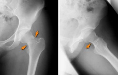 Стрес-перелом шийки стегнової кістки (переломи втоми, перелом напруги, insufficiency fractures)