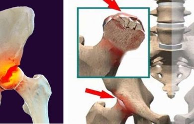 Асептичний некроз (остеонекроз, аваскулярний некроз) голівки стегнової кістки та стовбурові клітини в ортопедії-травматології