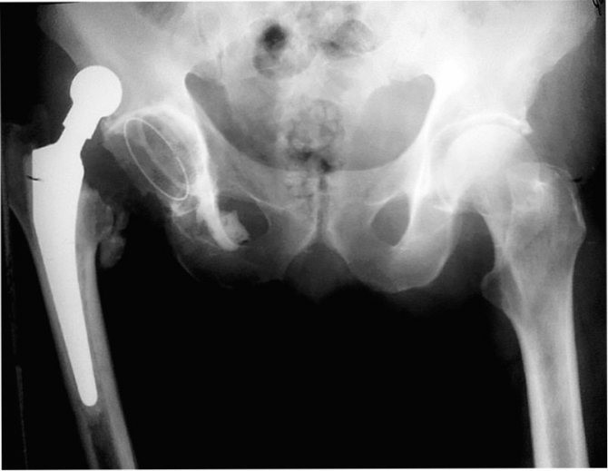 Вивихи ендопротезів – друга за частотою причина ревізійних втручань (4 місце за статистикою) після асептичного розхитування компонентів ендопротезів та пов'язаних з ним остеолізу та болю.