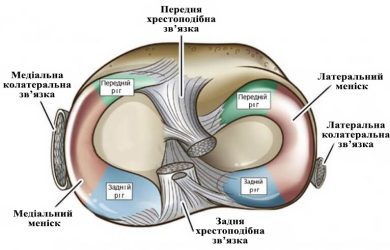 Артроскопічна меніскектомія (резекція меніска)