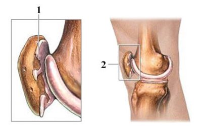 Хондромаляція надколінка
