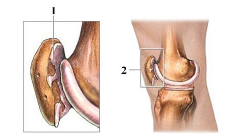 Хондромаляція надколінка
