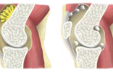 Хондроматоз колінного суглоба - Відділення травматології та ортопедії дорослих ДУ Національний інститут травматології та ортопедії НАМН України