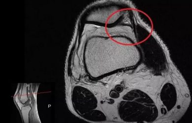 Синдром медіопателярної складки