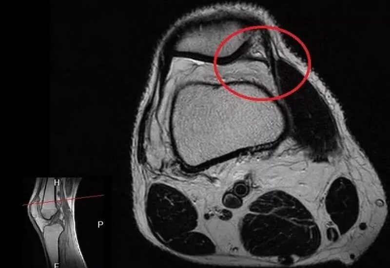 Синдром медіопателярної складки