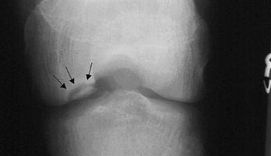 Хвороба Кеніга (розсікаючий остеохондрит колінного суглоба) – досить рідкісне захворювання, при якому розвивається обмежений остеонекроз ділянки субхондральної кістки, внаслідок чого відбувається дегенерація та відділення хрящової тканини в ділянці некрозу з подальшим зміщенням фрагмента в порожнину суглоба.