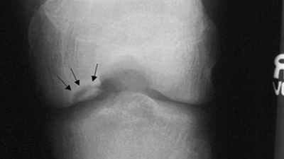 Хвороба Кеніга (розсікаючий остеохондрит колінного суглоба) – досить рідкісне захворювання, при якому розвивається обмежений остеонекроз ділянки субхондральної кістки, внаслідок чого відбувається дегенерація та відділення хрящової тканини в ділянці некрозу з подальшим зміщенням фрагмента в порожнину суглоба.