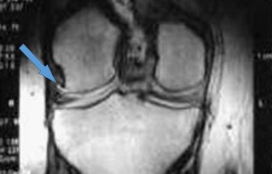 Рентгенологічна класифікація та діагностика остеоартриту. Чи потрібна допомога МРТ?