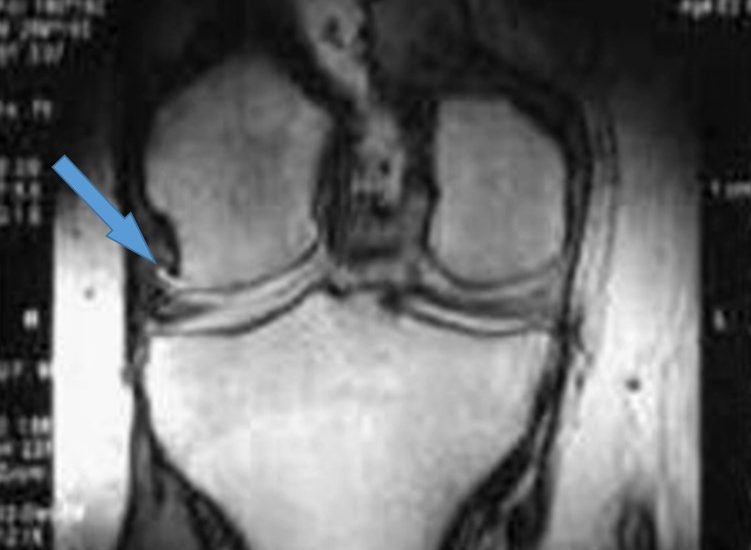 Рентгенологічна класифікація та діагностика остеоартриту. Чи потрібна допомога МРТ?