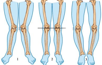 О-подібне викривлення ніг - варусна деформація нижніх кінцівок