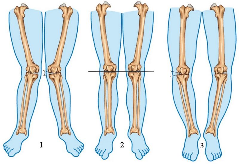 О-подібне викривлення ніг - варусна деформація нижніх кінцівок