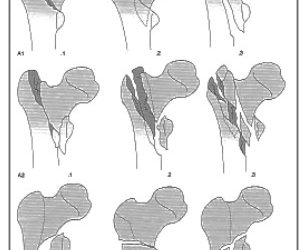 Сучасні тенденції у лікуванні вертлюгових переломів стегнової кістки: стержні, пластини, ендопротезування