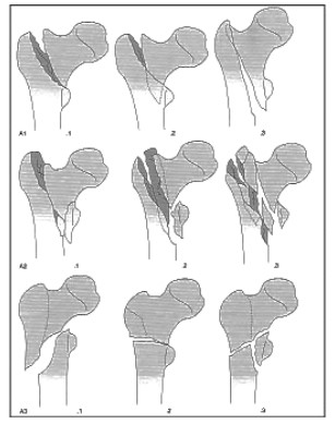 Сучасні тенденції у лікуванні вертлюгових переломів стегнової кістки: стержні, пластини, ендопротезування