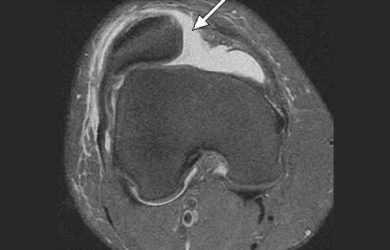 Звичний вивих надколінка (нестабільність надколінка). Причини, класифікація, симптоми, діагностика, лікування, реабілітація, профілактика та прогноз