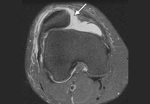 Звичний вивих надколінка (нестабільність надколінка). Причини, класифікація, симптоми, діагностика, лікування, реабілітація, профілактика та прогноз