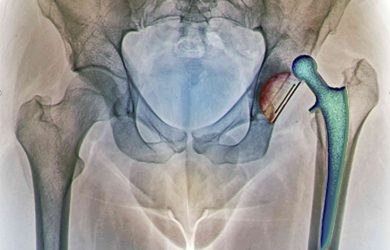 Ревізійне (повторне) ендопротезування кульшового суглоба. Причини, особливості та ризики.
