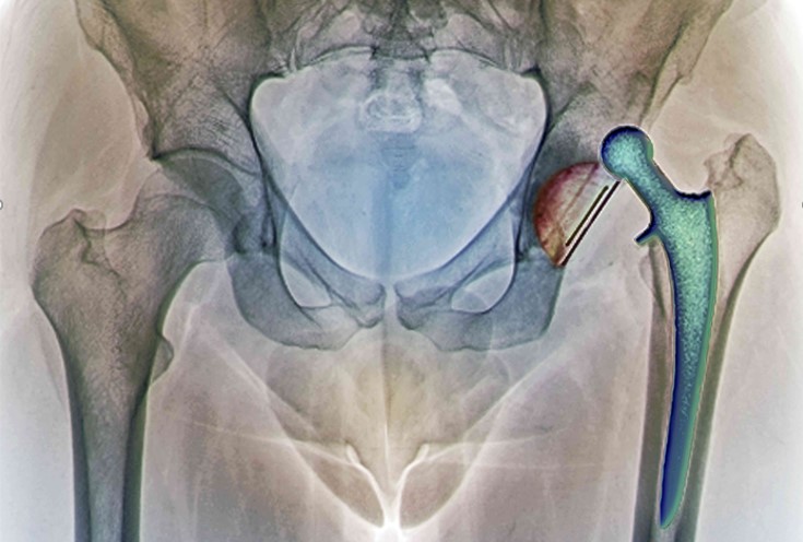 Ревізійне (повторне) ендопротезування кульшового суглоба. Причини, особливості та ризики.